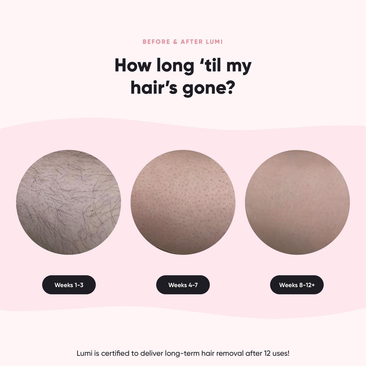 Lumi - Permanent Hair Removal Device