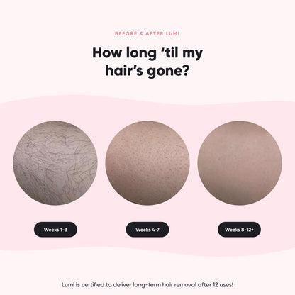 Lumi - Permanent Hair Removal Device